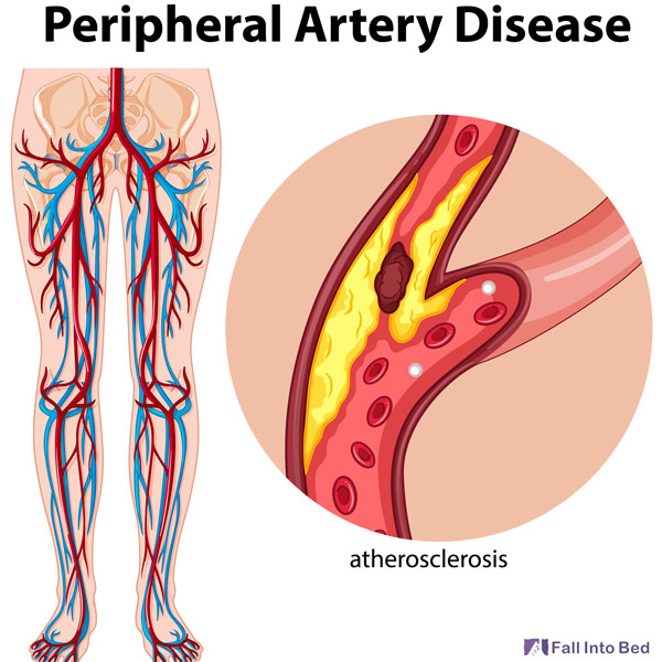 about peripheral artery disease