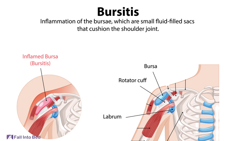 shoulder bursitis