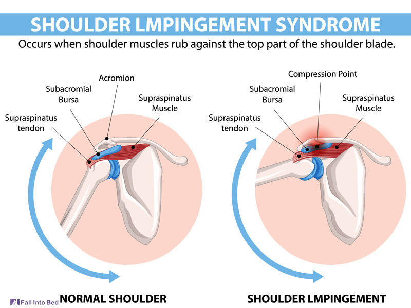 shoulder impingement 